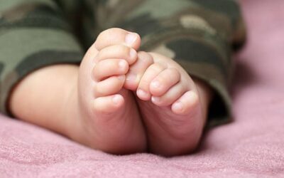 Clubfoot: Learn About Causes, Treatment, and Management of Clubfoot for Infants