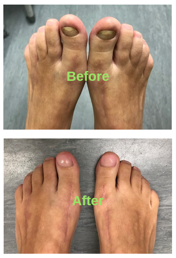 Keryflex Nail Restoration - Calgary Foot Clinic and Podiatrist